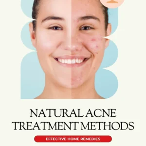 Natural Acne Treatment Methods